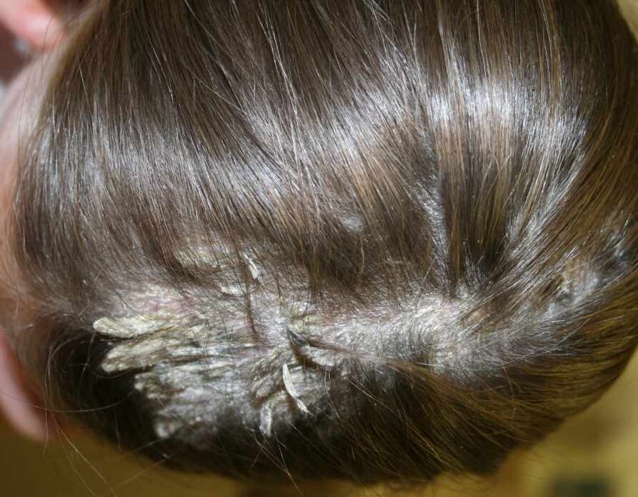 Psoriasis vun der Kopfhaut