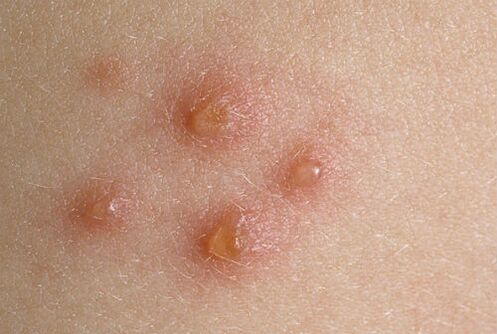 Hautknäppchen bei Psoriasis