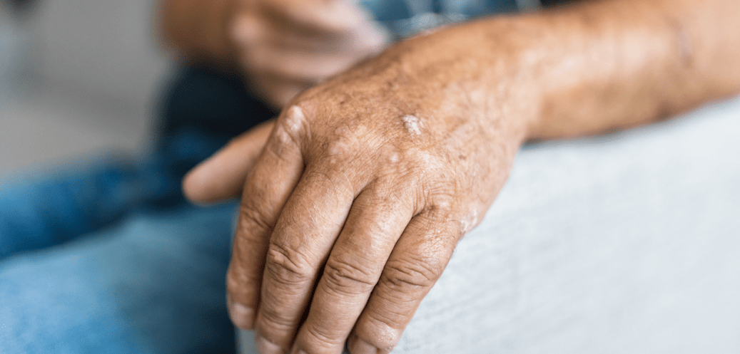 Psoriasis op der Haut vun der Hand