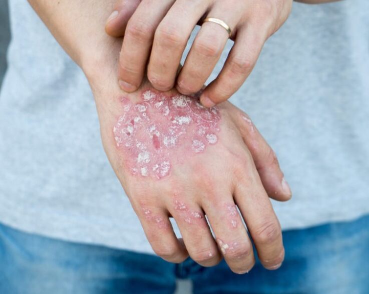 Psoriasis an den Hänn
