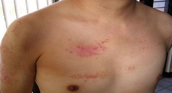 Psoriasis an der Brustberäich