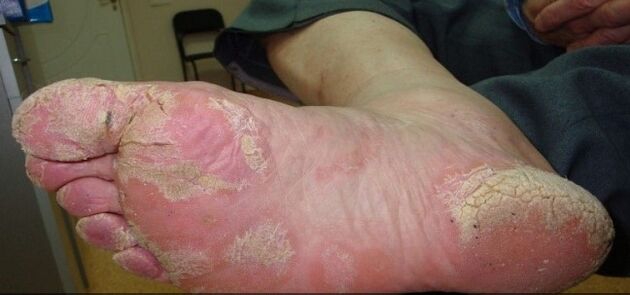 Psoriasis op de Been