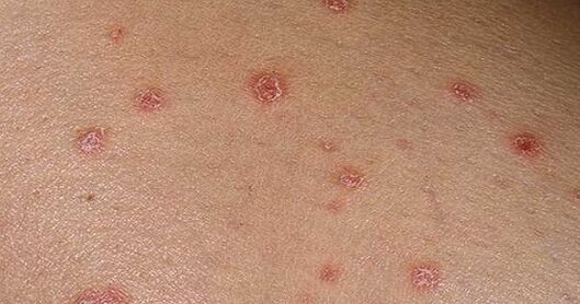 Psoriatic Placken