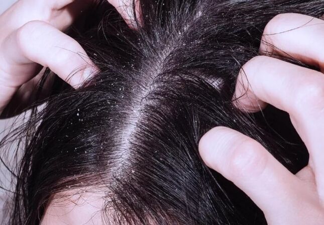 Psoriasis op de Kapp