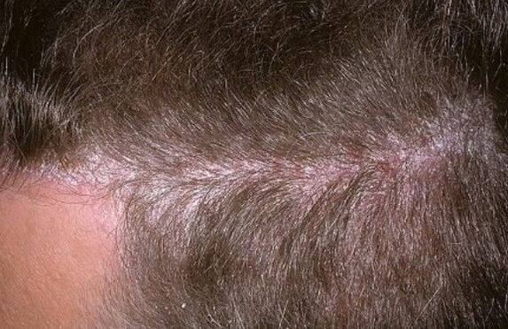 Psoriasis op de Kapp