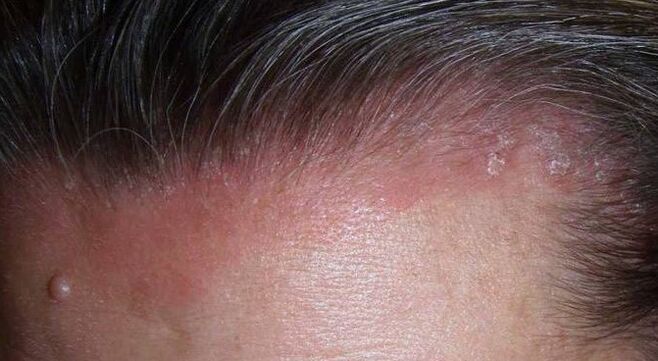 Wat ass Psoriasis