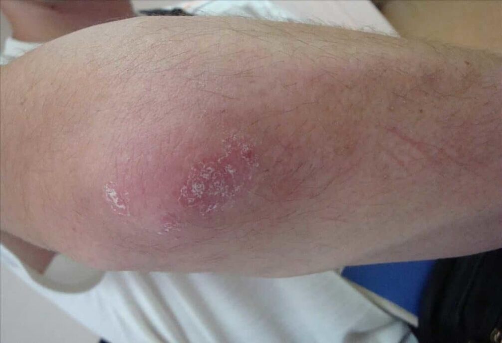 Wat Psoriasis ausgesäit