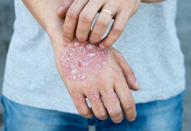 Mesticherred Psoriasis