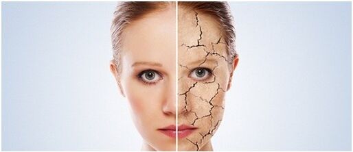 Mir behandelen PSORIASIS