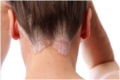 Psoriasis an den Hoer
