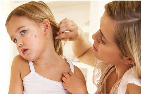 Psoriasis bei Kanner