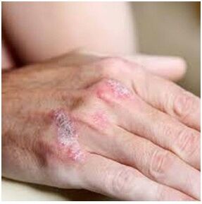 Psoriasis op der Pinsel