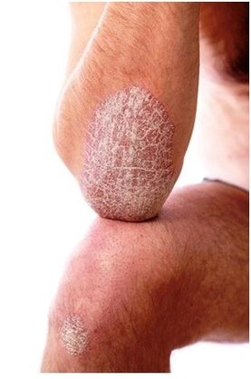 Psoriasis um Ellbog