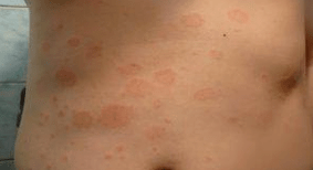 Onglécklech Psoriasis