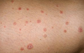 Psoriatic Placken