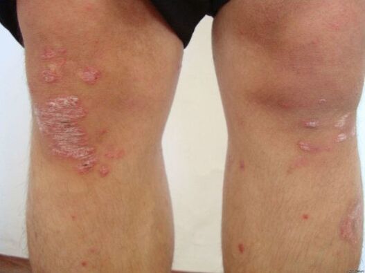 D'Ursaachen vun der Psoriasis