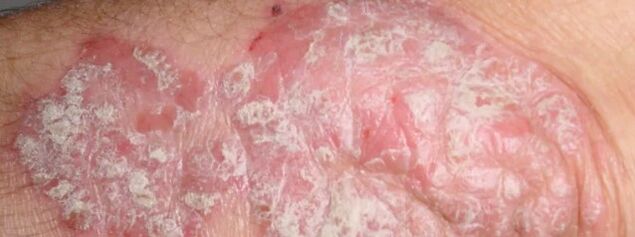 Mesticherred Psoriasis