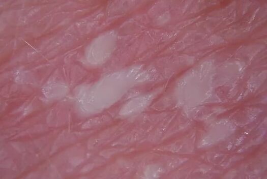 Pustulsenia Psoriasis