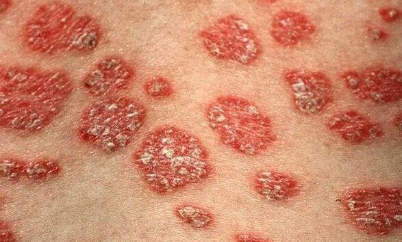 Formen vun der Psoriasis