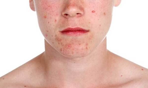 Symptomer vun der Psoriasis
