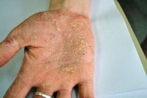 Psoriasis an der Handfläch vun Ärer Hand