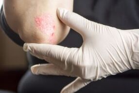 Psoriasis um Ellbog