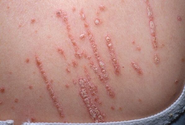 Psoriasis um Kierper