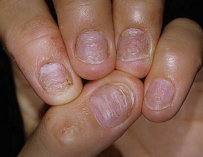 Psoriasis vun Neel