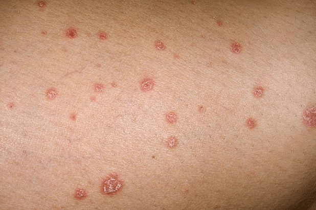 Psoriatesch Plaques