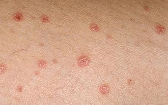 Psoriasis an der éischter Etapp