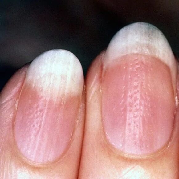 Nagel psoriasis
