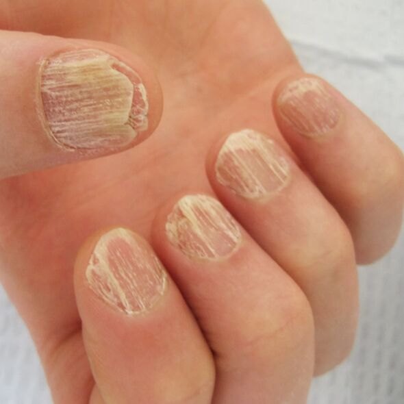 Nagelschued duerch Psoriasis