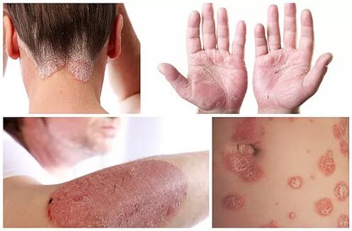 Manifestatiounen vun der Psoriasis op verschiddenen Deeler vum Kierper