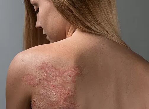 Psoriasis um Réck vun engem Meedchen
