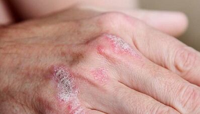 Symptomer vun der éischter Etapp vun der Psoriasis