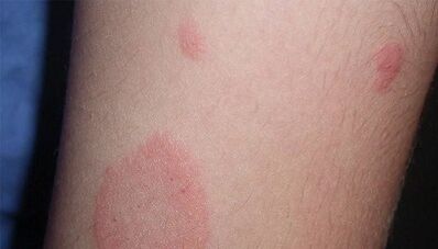 Wéi manifestéiert sech déi éischt Stuf vun der Psoriasis