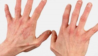 wéi gesäit déi éischt Stuf vun der Psoriasis aus