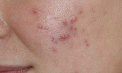 Symptomer vun der éischter Etapp vun der Psoriasis