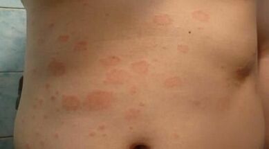 wéi d'Ufanksstadium vun der Psoriasis ze erkennen