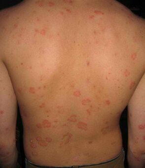 psoriasis op de Réck