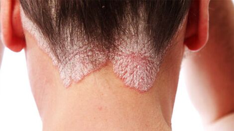 Psoriatesch Plaques op der Kopfhaut