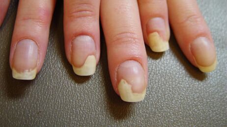Wäiss Flecken op den Nägel duerch Psoriasis