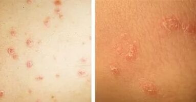Haapt Manifestatiounen vun Psoriasis