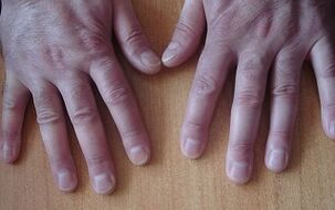 Symptomer vun der Psoriasis an der éischter Etapp