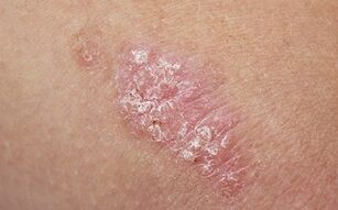 Ursaachen vun Psoriasis