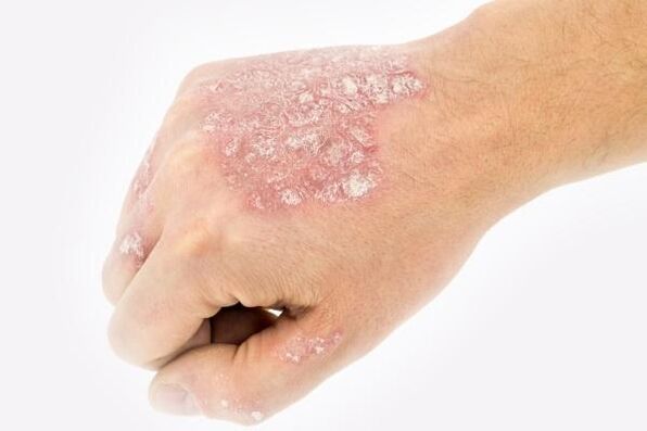 Mechanismus vun der Entwécklung vun Psoriasis op den Hänn