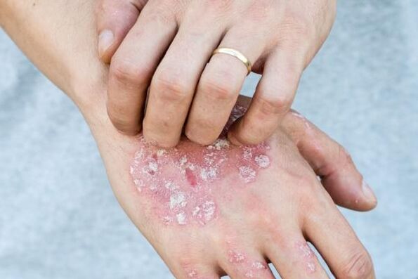charakteristesch Symptomer vun Psoriasis op den Hänn