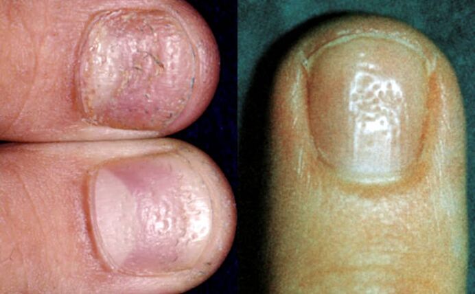 Fingerhoef Symptom - verschidde Depressiounen op der Uewerfläch vun der Nagelplack
