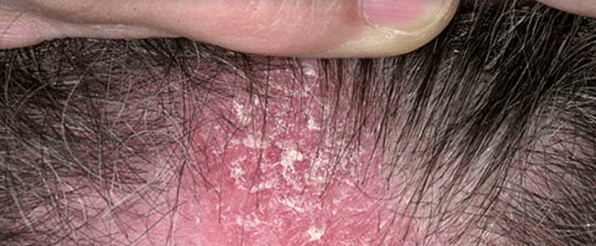 Haut Läsionen op der Kopfhaut mat Psoriasis